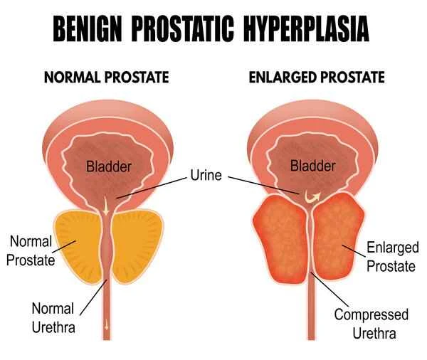 What medications are used to treat benign prostatic hyperplasia with calcification?
