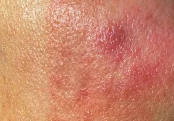 My glans penis has been red, swollen, and itchy for two days.