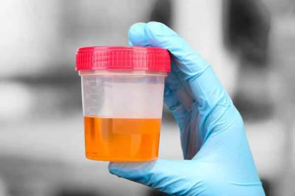 Red blood cells in urine test for chronic prostatitis