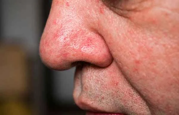 Does coronal sulcus defect cause itching of the glans penis?