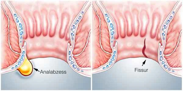 What medicine can help scrotal inflammation heal faster?