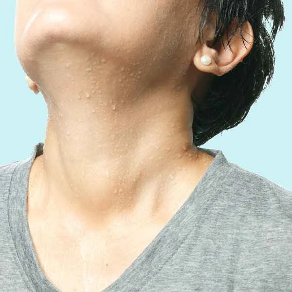 What causes excessive sweating of the scrotum?