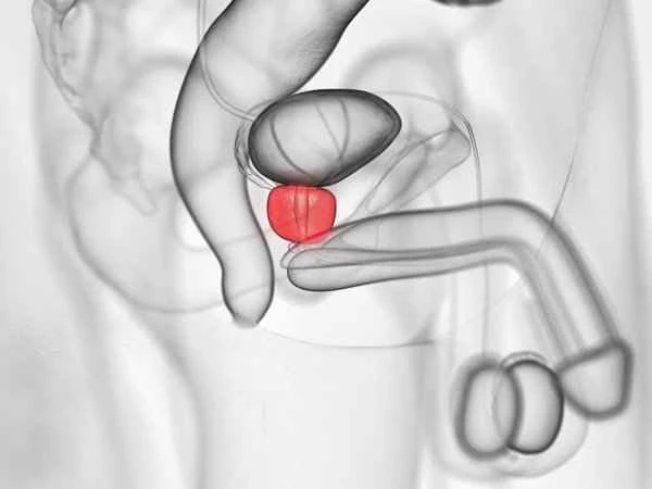 What causes scrotal smegma?