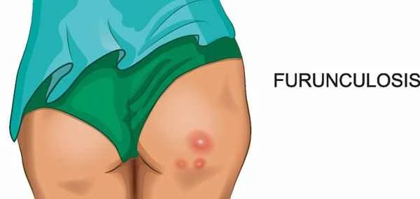 How to treat scrotal sweating?