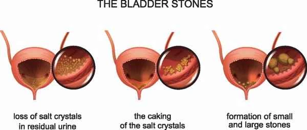 What medications are used to treat benign prostatic hyperplasia with calcification?