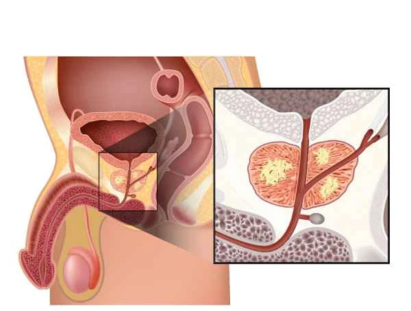 Why does prostatitis cause scrotal heat?