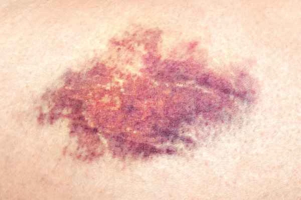 What could be causing a bruise on the scrotum?