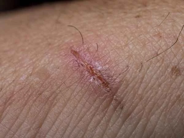 What causes scrotal stinging?