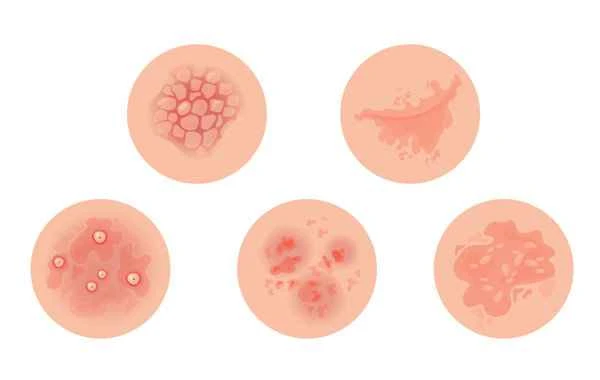 Recovery time for chronic prostatitis