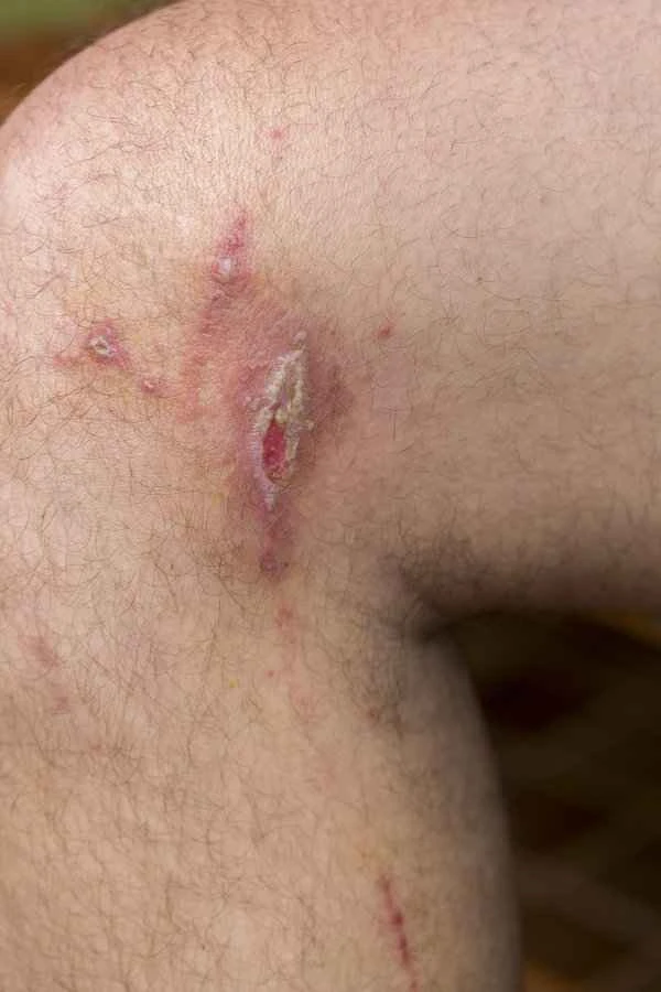 What causes scrotal stinging?