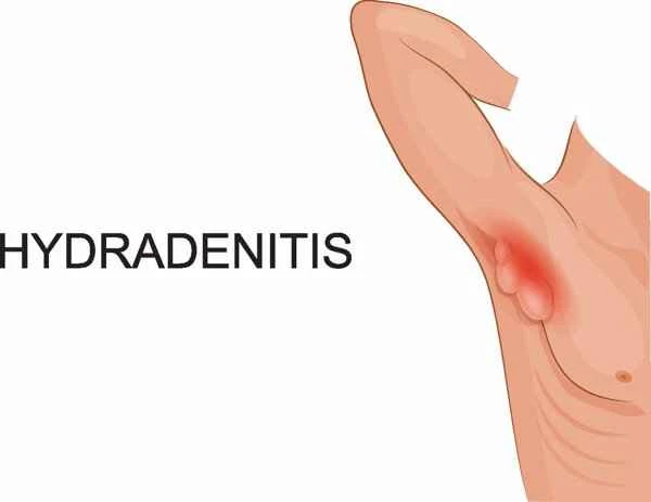 What ointment should I apply for scrotal inflammation?