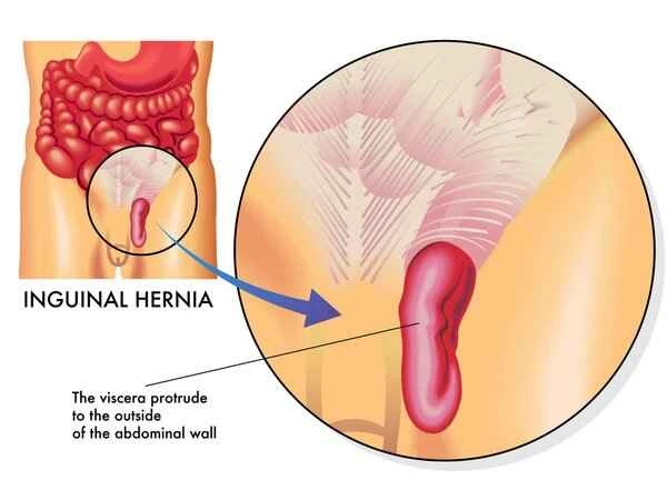 Is scrotal fibroma surgery painful?
