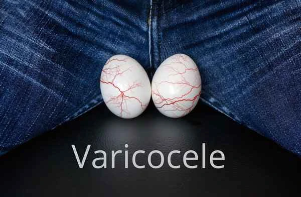 Is unilateral varicocele more serious?