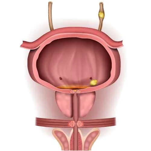Can chronic prostatitis be transmitted to the other person?