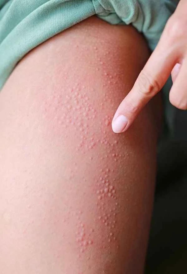 What medications are used for allergic scrotal dermatitis?