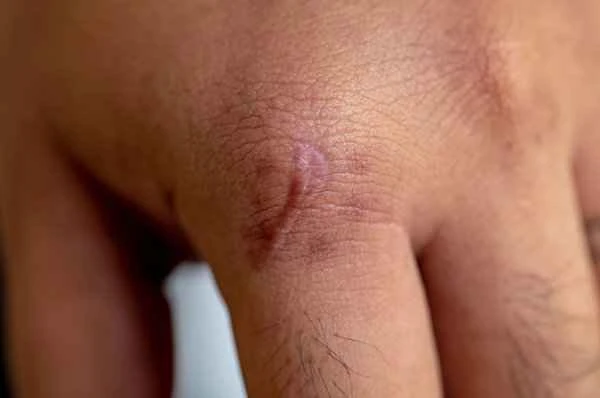 What causes itching from balanitis?