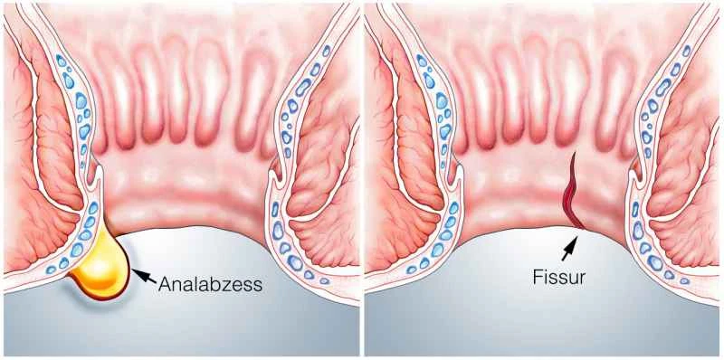 How long does it take to recover from acute prostatitis?
