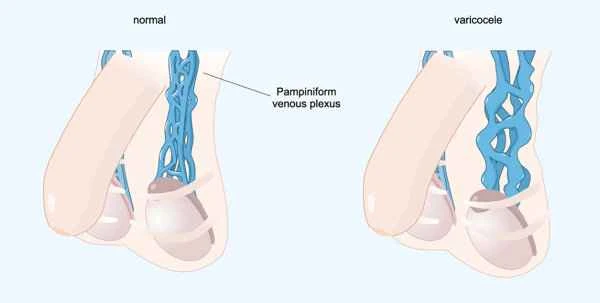 What constitutes symptoms of scrotal dampness?