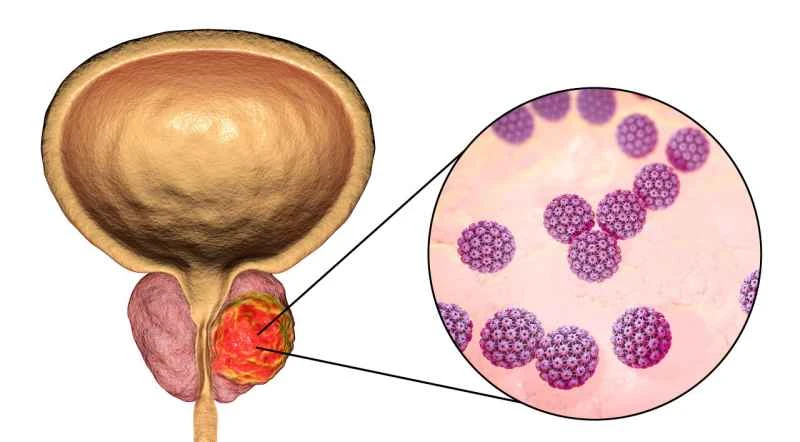 What causes bacterial prostatitis?