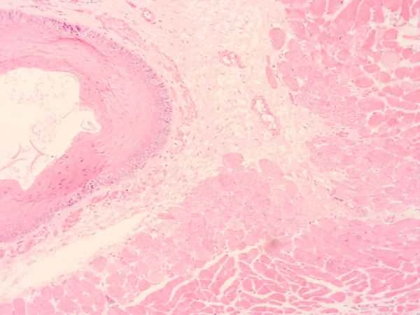 What does prostate calcification mean?