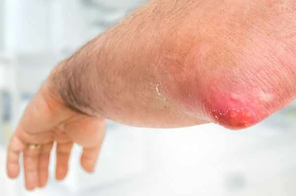 What to do about itching of the glans penis due to phimosis?