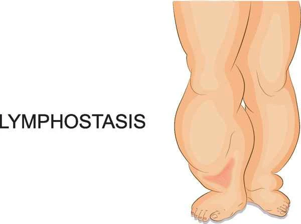 What causes scrotal hypertrophy?