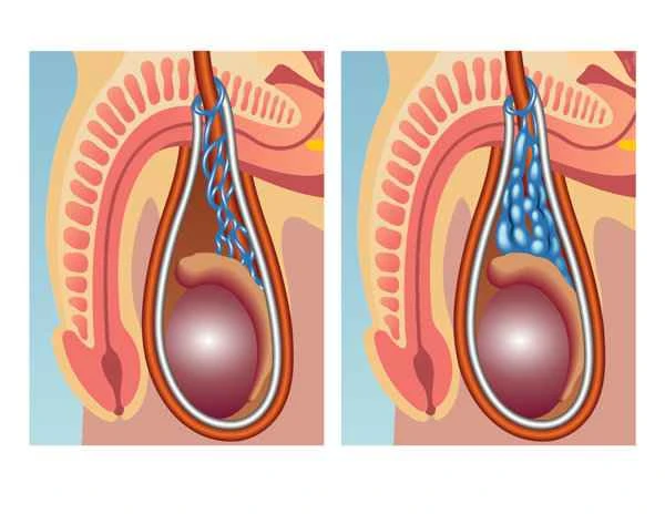 Can asthenospermia turn into azoospermia?