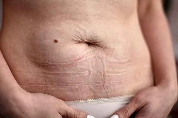 How to relieve pain from circumcision scars