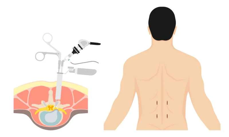 Can prostatitis be cured surgically?