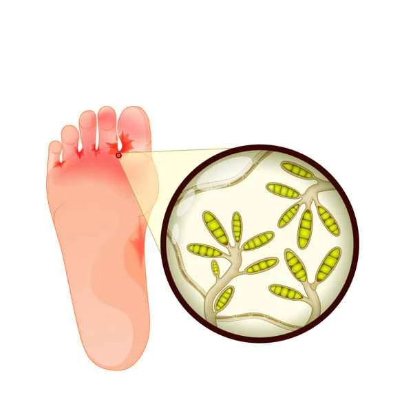 How to treat scrotal itching in men?