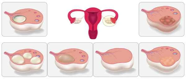 What causes the absence of semen?