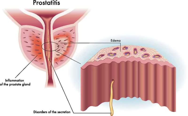 What herbal roots are good for treating prostatitis?