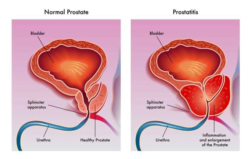 How long does it take to recover from mild prostatitis and return to normal life?