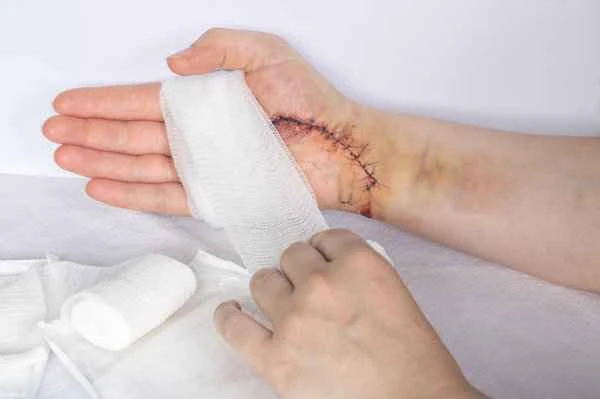 What to do if the scrotum is pinched and the penile vein is injured?