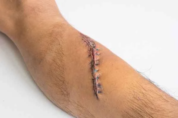 What causes pain on both sides of the scrotum?